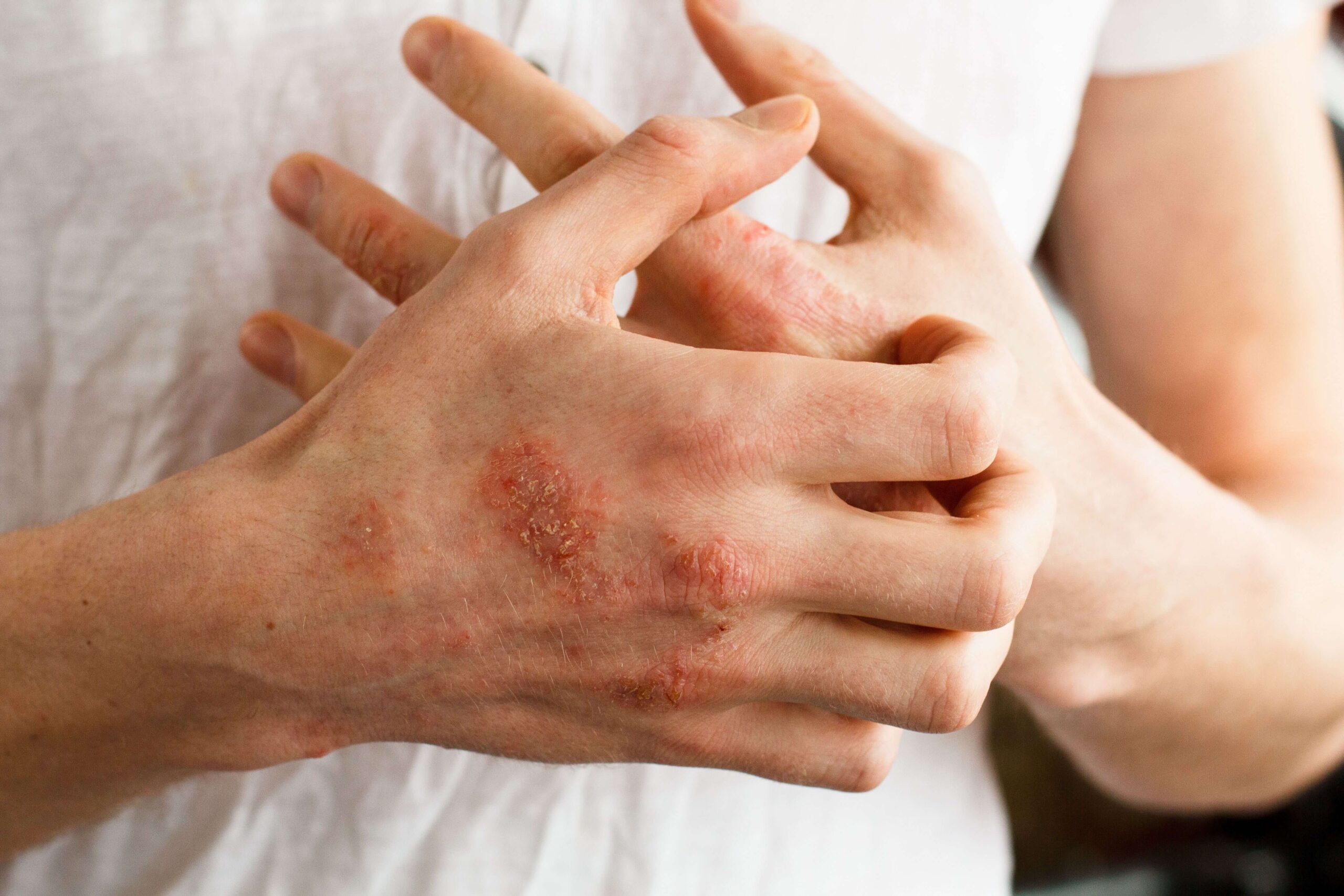 up close psoriasis on hand